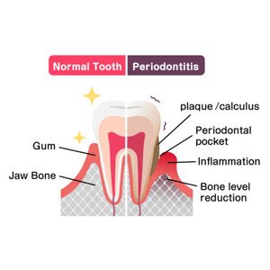 Umělecká fotografie Comparison of normal teeth and periodontal, Barks_japan, (40 x 30 cm)